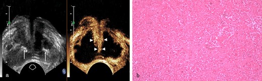 Prostate tuberculosis in a 56-year-old male. a, The axial TRUS examination demonstrated an enlarged prostate with the overall hypoechogenicity and some strip-like or dotted hyperechogenic area (arrows) inside. The axial CEUS examination demonstrated a large sheet-like non-enhanced area while strip-like enhancement (arrowheads) in the center of the prostate. b, Photomicrograph shows typical caseous necrosis. (Hematoxylin & eosin, ×100). CEUS, contrast-enhanced ultrasound; TRUS, transrectal ultrasonography.