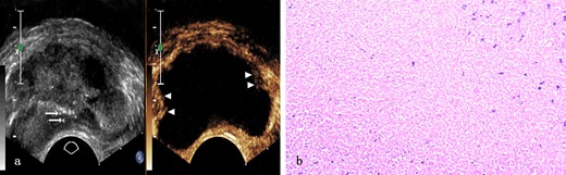 Prostate tuberculosis in a 31-year-old male. a, The axial TRUS examination demonstrated an enlarged prostate of generalized decreased echogenicity and some dotted hyperechoic area (arrows) inside. The axial CEUS examination demonstrated a large sheet-like non-enhanced area with some enhanced area only(arrowheads) in the peripheral zone. b, Photomicrograph shows typical caseous necrosis with some neutrophils inside. (Hematoxylin & eosin, ×100). CEUS, contrast-enhanced ultrasound; TRUS, transrectal ultrasonography.
