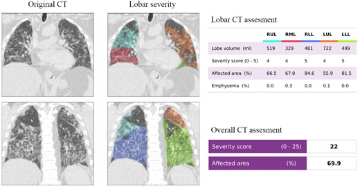 Representative example of a COVID-19 patient with a severity score of 22. The original and DL-assessed chest CT of a 76-year-old male patient, who had a positive RT-PCR test at the time of the CT examination.