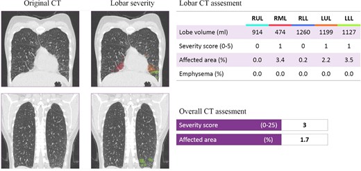 Representative example of a COVID-19 patient with a severity score of 3. The original and DL-assessed chest CT of a 41-year-old female patient, who tested negative for COVID-19.