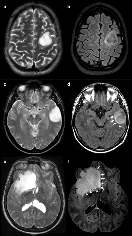 Positive cases for T2-FLAIR mismatch. T2 WI show a complete and homogeneous hyperintense signal (a, c and e) while on FLAIR sequences (b, d and f) the lesions show relatively hypointense signal when compared with T 2WI, except for a peripheral rim of hyperintense signal. Note that the degree of suppression on FLAIR imaging can be uniform (d and f) or inhomogeneous (b). Also, the peripheral high signal rim can be a thin contour circumscribing the whole lesion (b), or it can be an incomplete rim (d and f, arrows). (a, b) and (e, f) were IDH-mutant 1p/19q non-codeleted diffuse astrocytomas (grade II) and C-D was an IDH-mutant 1p/19q non-codeleted anaplastic astrocytoma (grade III). FLAIR, fluid attenuated inversion recovery; IDH, isocitrate dehydrogenase; WI, weighted image.