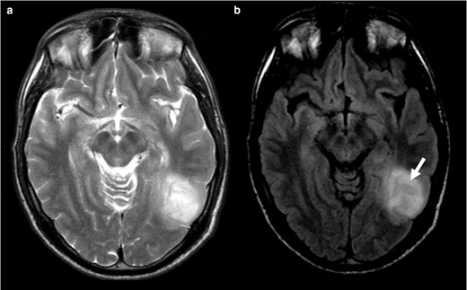 T2WI (a) shows a corticosubcortical lesion on the posterior temporal region on the left, without perfect homogenous high signal. On the FLAIR (b) image, the lesion displays central attenuation (arrow) with higher signal on periphery, however it does not have a nicely delineated rim). This should not be considered a T2-FLAIR mismatch sign. In this case the tumour was an IDH-mutant 1p/19q codeleted oligodendroglioma. FLAIR, fluid attenuated inversion recovery; IDH, isocitrate dehydrogenase.