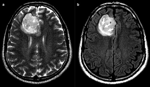 Clearly inhomogeneous T 2WI sign (a). Axial FLAIR images (b) have central lower signal intensity and higher peripheral rim (arrows). Evaluation of FLAIR image alone can be misinterpreted, while the inhomogeneous T2 precludes T2-FLAIR mismatch sign positivity. The tumour was an IDH-mutant 1p/19q codeleted oligodendroglioma. FLAIR, fluid attenuated inversion recovery; IDC, isocitrate dehydrogenase.