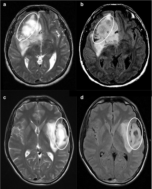 Negative cases for T2-FLAIR mismatch. T 2WI shows a heterogenous hyperintense signal in both lesions (a and c). FLAIR sequences (b and d) show areas of attenuation when compared with T 2WI (circles), but in an irregular fashion. In image d, we identify two distinct regions to this tumour, one of which shows evident attenuation on FLAIR (lateral part of the tumour), and the other that does not attenuate on FLAIR (medial/insular part). While the lateral region could be considered a positive T2-FLAIR mismatch sign, the medial part does not fulfill the criteria, so we classified this tumour as a negative case for T2-FLAIR mismatch. (a, b) was an IDH-mutant 1p/19q non-codeleted anaplastic astrocytoma (Grade III) and (c, d) an IDH-mutant 1p/19q non-codeleted diffuse astrocytoma (Grade II). FLAIR, fluid attenuated inversion recovery; IDC, isocitrate dehydrogenase.