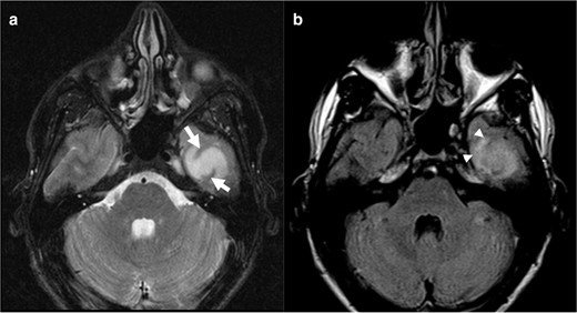 Axial T 2WI (a) reveals a bright signal intensity lesion on the left temporal region with linear areas of hypointense signal corresponding to the cortex (arrows). The lesion shows partially supressed signal on FLAIR image (b), without a complete high intensity peripheral rim, that can be seen on the anterior region (arrowhead). We considered a positive T2-FLAIR mismatch sign. This was an IDH-mutant 1p/19q non-codeleted diffuse astrocytoma (Grade II). FLAIR, fluid attenuated inversion recovery; IDC, isocitrate dehydrogenase.
