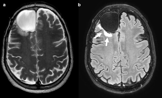 T2-FLAIR mismatch sign negative. Axial T 2WI (a) showing cortico-subcortical lesion with homogeneously bright signal intensity in right frontal region. Axial FLAIR scan (b) reveals strong hypointense signal intensity in the same area, revealing a cystic formation, not a true T2-FLAIR mismatch sign. The peripheral edema (arrows) should not be misinterpreted as a bright sign rim. This was an IDH-mutant 1p/19q codeleted oligodendroglioma. FLAIR, fluid attenuated inversion recovery; IDC, isocitrate dehydrogenase.