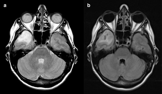 T2-FLAIR mismatch sign negative. On the axial T 2WI (a) there is a cortico-subcortical lesion with homogeneously bright signal intensity on T2 in the right temporal pole. Axial FLAIR scan (b) reveals inhomogeneous attenuation of signal intensity in the central area, with some darker areas in the middle of the lesion. Although these characteristics could point to the presence of the mismatch sign, there is no clear peripheral bright rim and the drop of signal on FLAIR is not as homogeneous as expected for a T2-FLAIR mismatch sign. This was an IDH-mutant 1p/19q codeleted oligodendroglioma. FLAIR, fluid attenuated inversion recovery; IDC, isocitrate dehydrogenase.