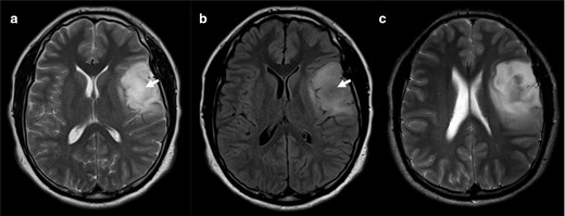 Axial T 2WI scan through the middle region of the lesion (a) shows an almost homogenous T2 bright signal intensity. On the FLAIR (b) there is central suppression of the signal (arrow). However, we should evaluate the whole length of the lesion and an upper slice (c) reveals that the lesion is heterogenous on T 2WI, not fulfilling the criteria for the T2-FLAIR mismatch. This was nevertheless an IDH-mutant 1p/19q non-codeleted diffuse astrocytoma (Grade II). FLAIR, fluid attenuated inversion recovery; IDC, isocitrate dehydrogenase.
