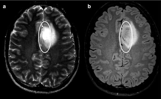 Axial T 2WI (a) shows homogenous high signal intensity (circle) but only part of the lesion supresses on the FLAIR image (circle on b). Following the criteria, this should be considered a negative T2-FLAIR mismatch sign, although this turned out to be an IDH-mutant 1p/19q non-codeleted diffuse astrocytoma (Grade II). FLAIR, fluid attenuated inversion recovery; IDC, isocitrate dehydrogenase.