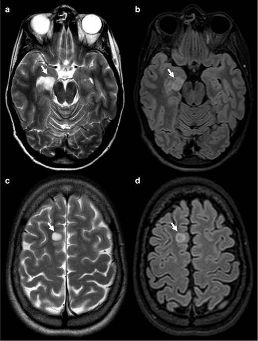 Axial T 2WI (a, c) show homogenous high signal intensity (arrows) with central attenuation on the FLAIR image (b, d), corresponding to what should be a positive T2-FLAIR mismatch sign. Top row tumour was a DNT and bottom row a neuroglial tumour.DNT, dysembryoplastic neuroepithelial tumour; FLAIR, fluid attenuated inversion recovery.