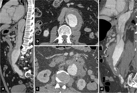 CT angiogram images of type B aortic dissection at presentation (a, b) and a year later (c, d) showing secondary infection of the abdominal aorta. Note the periaortic air (marked by arrows), fat stranding and irregularity of the aortic contour (c, d).