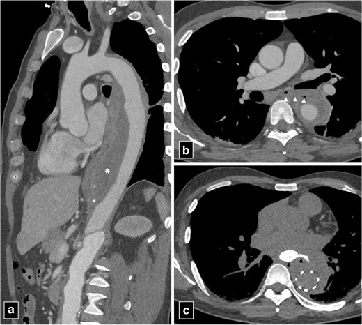 CT angiogram images of type B aortic dissection with thrombosed false lumen (marked by asterisk in a) with aorto-esophageal fistula (arrowheads in b). The patient was managed with bridging thoracic endovascular repair. Note the extravasation of column of oral contrast (arrowheads in c) communicating with the excluded false lumen of the aortic dissection post-endovascular repair.