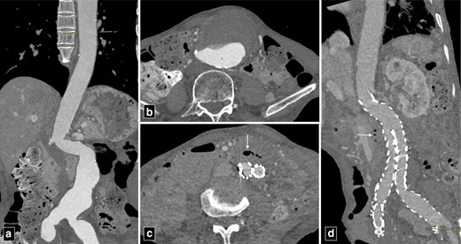 CT angiogram images of abdominal aortic aneurysm at presentation (a, b). CT angiogram post-endovascular repair of abdominal aorta showing air foci in the thrombosed segment of the aneurysm (arrow in c, d). Note the absence of periaortic thickening, lymphadenopathy or fat stranding to suggest infection.