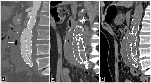 Post-operative images of abdominal aortic aneurysm managed with endovascular aortic repair. The periaortic air foci seen on day 10 (a) showing significant reduction on day 20 (b) and the absence of air foci on day 30. Note the absence periaortic thickening, lymphadenopathy or fat stranding to suggest infection.