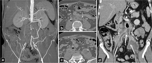 CT angiogram maximum intensity projection image of aorto bi-iliac occlusion (a), managed with surgical aorto bi-iliac graft. The infection of the surgical graft with complete occlusion, intraluminal and periaortic air (arrows in b, c) along with periaortic stranding and luminal irregularities (arrows in d).