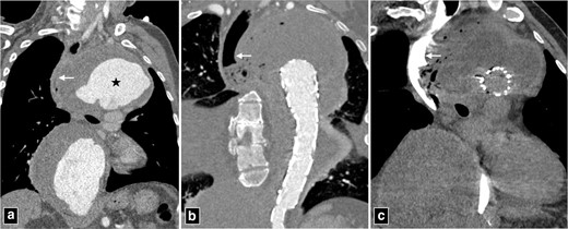 CT angiogram of thoracic aortic aneurysm (marked by star in a) with peripheral thrombosis causing indentation and displacement of oesophagus (arrow in a). The patient was managed with thoracic endovascular repair and developed secondary aorto-oesophageal fistula (b, c). Note the rupture of wall of oesophagus and continuous column of air communicating with excluded portion of the aneurysm.