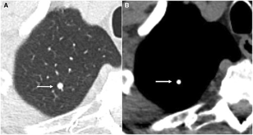 Axial CT lung window (A) and soft tissue window (B) showing calcified granuloma (arrow).