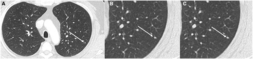 Axial CT (lung window) (A) and magnified view (B) in 19-year-old patient with Ewing sarcoma showing indeterminate lung nodule (arrow—3 mm) in left lower lobe (A, B) which was unchanged on 3 months follow up CT (C).