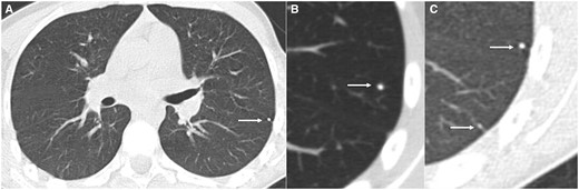 Axial CT (lung window) (A) and magnified view (B, C) in 20 year old patient with osteosarcoma showing multiple indeterminate lung nodules (arrow—4 and 2 mm) in left lower lobe.