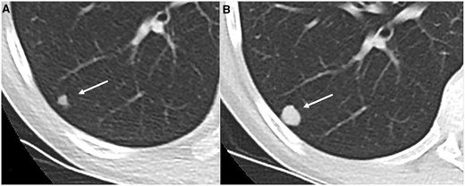 Axial CT (lung window) magnified view (A, B) in 19 year old patient with Ewing sarcoma showing indeterminate lung nodule (arrow—6 mm) in right lower lobe (A) which increased in size (14 mm) on 3 months follow up CT (B).