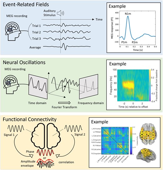 Types of MEG signals. The top-panel shows event-related fields: the schematic shows how time and phase locked signal fluctuations can be averaged over trials to create an evoked response. The example on the right shows a typical response to an auditory tone. From Hajizadeh A, Matysiak A, May PJC, König R. Explaining event-related fields by a mechanistic model encapsulating the anatomical structure of auditory cortex. Biol Cybern. 2019;113(3):321-345. doi: 10.1007/s00422-019-00795-9; http://creativecommons.org/licenses/by/4.0/)13. The middle panel shows a neural oscillatory modulation. In the schematic, we show how a single oscillatory waveform can be decomposed into its constituent frequency bands. The example on the right from Hill RM, Devasagayam J, Holmes N, et al. Using OPM-MEG in contrasting magnetic environments. Neuroimage. 2022;253:119084. doi: 10.1016/j.neuroimage.2022.119084; http://creativecommons.org/licenses/by/4.0/14 shows a time-frequency spectrogram with modulation of gamma (30+ Hz) activity during a task where subject watch a visual stimulus. Blue reflects a decrease and yellow reflects an increase in amplitude relative to the baseline (here baseline is defined as −3.4 to −2.5 seconds). The bottom panel shows functional connectivity. The schematic shows how it is possible to derive waveforms from spatially separate brain regions and look for a relationship between them. The example on the right from Boto E, Hill RM, Rea M, et al. Measuring functional connectivity with wearable MEG. Neuroimage. 2021;230:117815. doi: 10.1016/j.neuroimage.2021.117815; https://creativecommons.org/licenses/by/4.0/15 shows a matrix representing connectivity between a set of parcellated brain regions. The ‘glass brain’ shows the spatial signature of the strongest 200 connections. In this example, we show beta band connectivity, which is strongest in the sensorimotor system15. Abbreviation: MEG = magnetoencephalography.