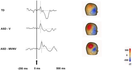 Delayed auditory event related field in ASD (adapted from Roberts TPL, Matsuzaki J, Blaskey L, et al. Delayed M50/M100 evoked response component latency in minimally verbal/nonverbal children who have autism spectrum disorder. Mol Autism. 2019;10:34. doi: 10.1186/s13229-019-0283-3; https://creativecommons.org/licenses/by/4.040): The 3 waveforms show representative auditory evoked responses in a typically developing (TD) child (top), a verbal child with ASD who has no intellectual disability (ASD-V; middle) and minimally verbal or nonverbal child (MVNV) with ASD (bottom). The gray lines indicate the expected response at 50 ms (M50 peaks). For the representative TD child a response was observed around 71 ms, for the representative ASD-V child at 81 ms, and for the representative ASD-MVNV child at 98 ms. Abbreviations: ASD = autism spectrum disorder.