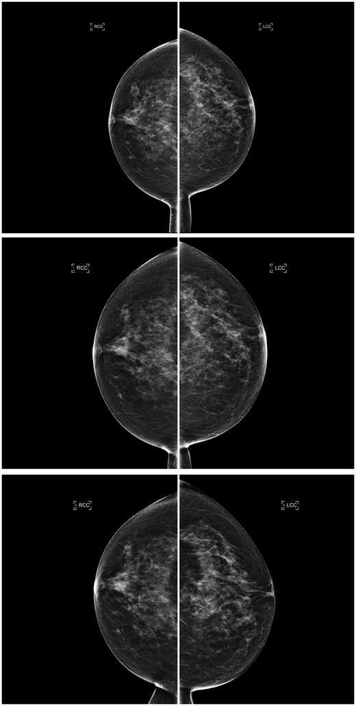 Consecutive craniocaudal mammographic views acquired in the year 2019 (top), 1 year later (middle), and 2 years later (bottom) of the same woman. An ascending longitudinal density pattern was produced by the interpreting radiologists due to inter/intra-observer variability who assigned BI-RADS density categories b, c, and d, respectively, whereas the AI density model assigned BI-RADS density category c to all 3 examinations, producing a constant longitudinal density pattern. Abbreviations: BI-RADS = Breast Imaging Reporting and Data System; AI = artificial intelligence.