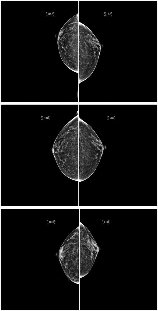 Consecutive craniocaudal mammographic views acquired in the year 2017 (top), 3 years later (middle), and 4 years later (bottom) of the same woman. The interpreting radiologists and the AI density model agreed on the same ascending longitudinal density pattern and assigned BI-RADS density categories b, b, and c, respectively, capturing potential weight loss between the last 2 years (as suggested by the reduction in compressed breast thickness of the left and right breasts from 4.9/5.0 cm to 3.1/3.1 cm). Abbreviations: AI = artificial intelligence; BI-RADS = Breast Imaging Reporting and Data System.