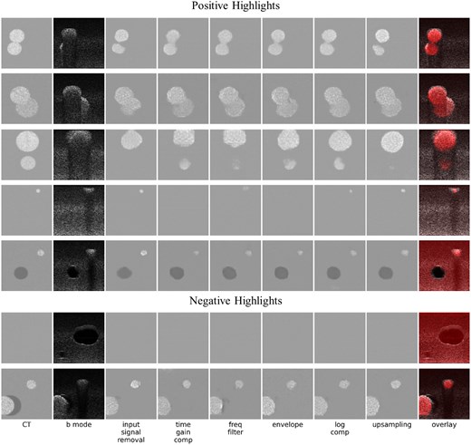 This figure shows some positive (rows 1-5) and negative (rows 6 and 7) highlights of image conversion, chosen as exemplary for various qualitative observations made. Column 1 (left) shows ground truth simulated computed tomography (CT) images. Column 2 shows simulated B-mode images. Columns 3-8 show the output of the ML model when trained on different stages of the ultrasound signal processing pipeline: after input signal removal, time gain compensation, frequency filtering, envelope detection, log compression, and upsampling (results using raw scan lines as input are omitted due to their inferior performance, see Figure 2). The final column shows generated CT images in red (using the average image intensities of the 6 previous columns, normalized to cover the entire dynamic range) superimposed on a B-Mode image.