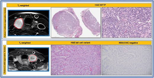 T2 weighted MR and histopathologic images of patients with and without aggressive tumour features. Top Row: The H&E shows NIFTP, noninvasive follicular thyroid neoplasm with papillary-like nuclear features, showing noninvasive well circumscribed borders and follicular growth pattern. Bottom Row: The H&E shows papillary thyroid carcinoma, tall cell variant as well as the negative IHC for oncogenic NRASQ61R, an activating mutation of RAS oncogene.