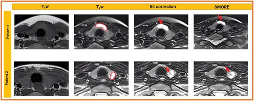 T1w images and fat-suppressed T2-weighted images for 2 patients demonstrate STIR hyperintense tumour in the thyroid isthmus (patient 1, ROI) and T2 heterogeneous tumour in the right thyroid lower pole (patient 2, ROI). Image quality for both patients is maintained between N4 bias-field corrected images and SMORE images, noting tumour visibility without significant artefacts.