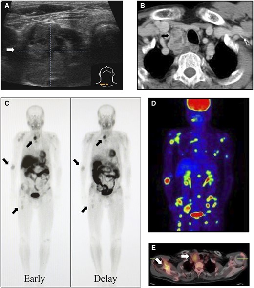 Neck ultrasonography (A) and contrast-enhanced computed tomography (B) show an internally heterogeneous mass at the lower pole of the right lobe of the thyroid gland with an indistinct boundary with the surrounding tissue. 99mTc-MIBI scintigraphy (C) shows abnormal accumulation in the superior mediastinum and multiple bone. 18F-FDG PET/CT also shows a weak accumulation in the superior mediastinum (D) and a strong accumulation of multiple bone (E). 18F-FDG PET/CT = 18F-fluorodeoxyglucose-positron emission tomography/computed tomography; 99mTc-MIBI = 99m Tc-methoxy isobutyl isonitrile.