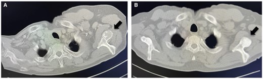 Osteolytic lesions of the scapula preoperatively (A) show sclerotic changes at 6 months postoperatively (B).