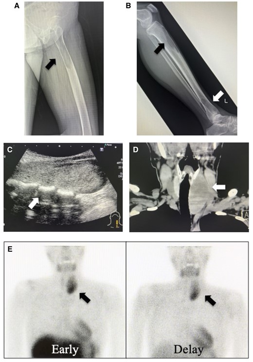 Plain radiographs of the femur (A) and tibia (B) show multiple osteolytic lesions. Neck ultrasonography (C) and computed tomography (D) show an 80 mm tumour behind the left lobe of the thyroid gland. 99mTc-MIBI scintigraphy (E) shows abnormal accumulation in the superior mediastinum. There is no accumulation in the bone lesions. 99mTc-MIBI = 99m Tc-methoxy isobutyl isonitrile.