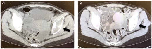 Osteolytic lesions of the pelvis preoperatively (A) show sclerotic changes at 6 months postoperatively (B).