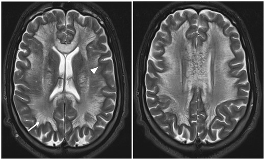 Axial T2-weighted slices depict diffuse bilateral white matter lesions respecting the U fibres (arrowhead) and exhibiting the characteristic “spongiform” appearance described in HLE, this refers to the visualization of vacuoles with a quasi-liquid signal located between the nerve fibres (arrow). Abbreviation: HLE = heroin-induced leukoencephalopathy.