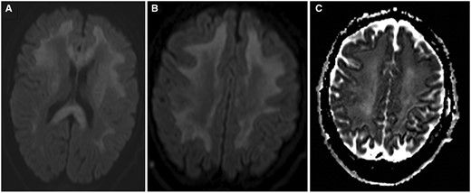 DWI images at two different levels illustrating diffusion restriction scattered within the white matter lesions (A, B), confirmed on the ADC cartography (C). Abbreviation: DWI = diffusion-weighted imaging.