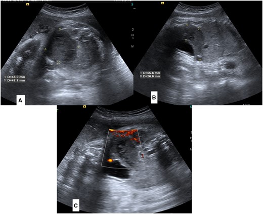 (A–C) Antenatal sonography images of foetal lower abdomen and pelvis. Sagittal (A) and Axial (B) images show a dilated pouch-like structure posterosuperior to urinary bladder (marked by asterisks). Colour doppler images (C) is showing absence of any colour flow in lesion.