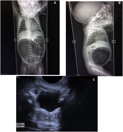 (A–C) Postnatal imaging at 24 h of life. Xray abdomen supine AP (A) and lateral (B) view showing grossly distended air-filled pouch in lower abdomen. USG scan of pelvis of baby (C) showing Didelphis uterus (marked by asterisks).