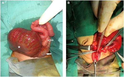 (A and B) per-operative images. (A) Dilated pouch colon (marked by star), proximal normal colon (white block arrow) and small bowel loops (hollow arrow). (B) Ligation and division of fistula (marked by hollow arrow).