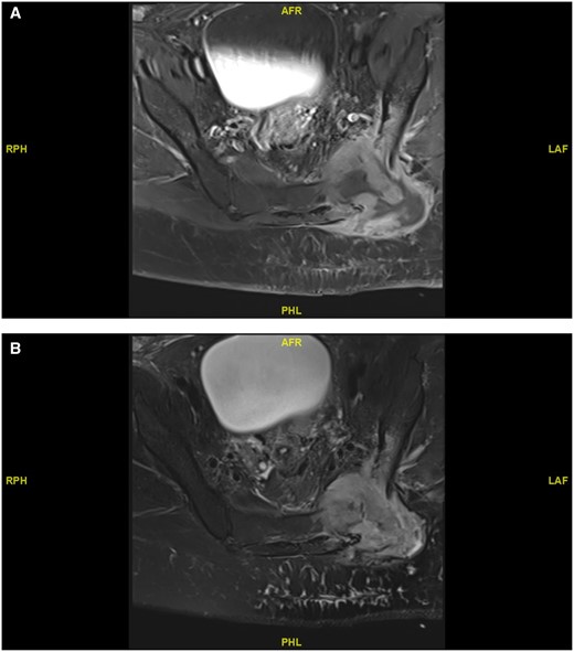 MRI axial (A) T1-weighted and (B) T2-weighted image showing osteomyelitis and cellulitis in the left gluteal region of the lower back.