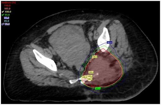 Axial view of the left gluteal region after palliative external beam radiation involving 4 Gy administered over two fractions using the volumetric modulated arc therapy technique.