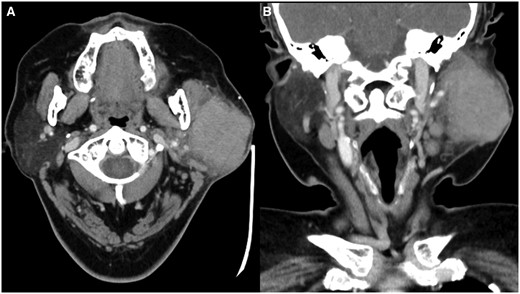 Contrast-enhanced CT ((A) axial; (B) coronal) shows an ill-defined enhancing lesion occupying almost the entire superficial left parotid gland with protrusion into the deep lobe.