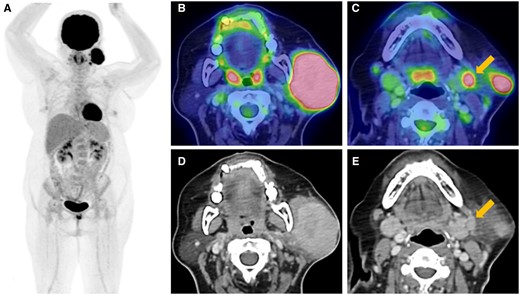 Fluorine-18 fluorodeoxyglucose PET CT ((A) maximum intensity projection; (B, C) axial hybrid; (D, E) axial CT) shows a hypermetabolic left parotid mass (B, D) and left cervical level Ib nodal metastases (C, E).