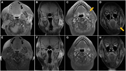 Post-contrast T1 weighted MRI with fat suppression performed 3 months (A-D) and 5 months (E-H) after completion of radiotherapy. First MRI shows significant decrease in size of the left parotid tumor ((A) axial, (B) coronal) and left cervical nodal metastases (arrows, (C) axial, (D) coronal). Second MRI shows further decrease in size of the left parotid tumour ((E) axial, (F) coronal) and resolution of the left cervical nodal metastases ((G) axial, (H) coronal).