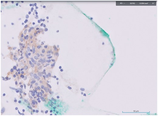 Immunohistochemical staining of the initial cytology specimen from the primary tumour showed expression of SSTR2 (stained brown) on the tumour cells (stained purplish blue).
