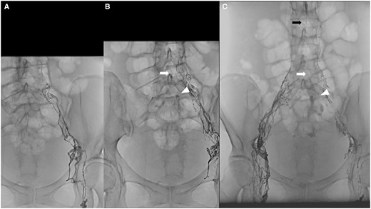 (A) Fluoroscopic images obtained 10 min after initiating injection of the contrast agent show progression of the lipiodol through the left iliac and lumbar lymphatic ducts; however, there is no definite extravasation. (B) Fluoroscopic image obtained 25 min after the initial injection of lipiodol through the left inguinal node. Extravasation of diluted lipiodol is noticeable at the level of the first sacrum (arrowhead). A linear opacity in the midline corresponding to descending lipiodol flow was also found (white arrow). (C) Fluoroscopic image obtained 85 min after the initial injection of lipiodol shows diluted lipiodol reflux from the cisterna chyli (black arrow), descent of the anterior aspect of the lumbar spine (white arrow), and extravasation at the level of the first sacrum (arrowhead).