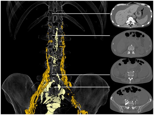 Three-dimensional volume rendering (left) shows anterograde lipiodol (yellow) and descending and refluxing lipiodol (light yellow). Cross-sectional CT images at several levels (right) show that the midline descending lipiodol corresponds to retroperitoneal paraaortic lymphatic vessels. The top image shows that lipiodol does not flow into the thoracic duct at all. The second image from the top shows the level of the cisterna chyli.