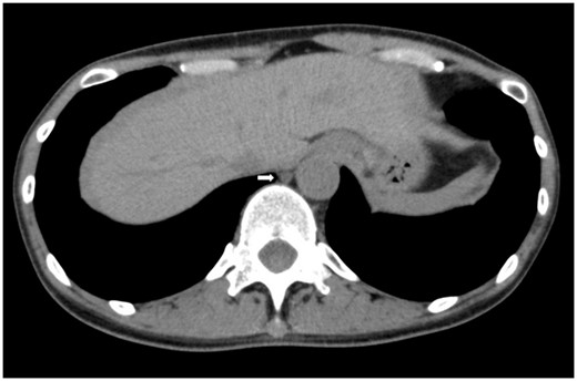 CT obtained 40 days after surgical repair shows no ascites and an enlarged thoracic duct (arrow).