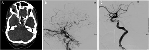 (A) CT angiography showed left carotid-cavernous fistula (CCF) with a 6 mm aneurysm (white arrow). (B) Angiography of CCF pre-embolization. (C) Post-embolization of CCF.
